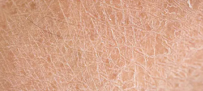 How to Prevent Dry Winter Skin